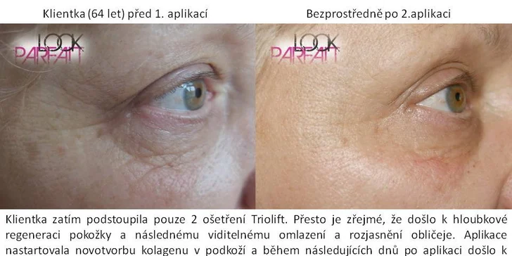 Facelift bez skalpelu - okamžité vyhlazení vrásek