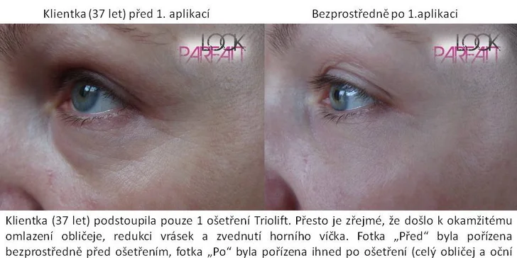 Facelift bez skalpelu - okamžité vyhlazení vrásek