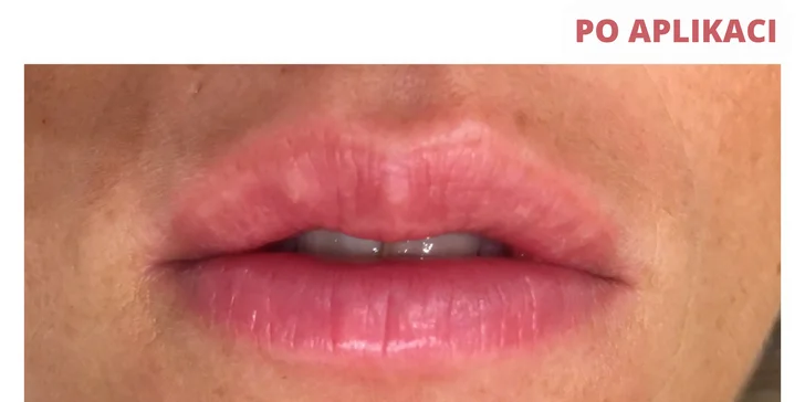 Výsledkem neinvazivní výplně rtů pak budou budou krásné, oslnivé a přirozeně plnější rty.