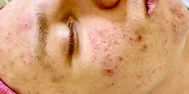 Algae peel po prvom ošetrení