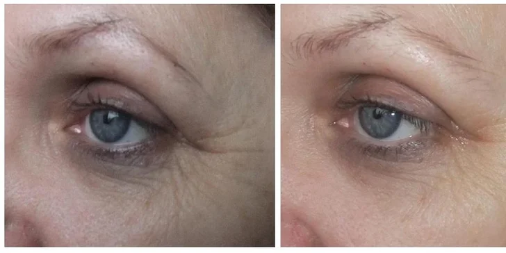 Poze Manuálni Facelifting. Obrázek není nijak upravován. Změna světla byla závislá na denní době.