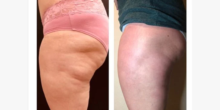 Výsledek ošetření po 5 aplikacích ultrazvukové liposukce kombinované s přístrojovou lymfodrenáží