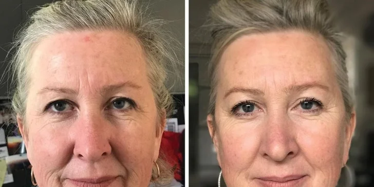 výsledek po 6 měsících po celoobličejovém faceliftingu