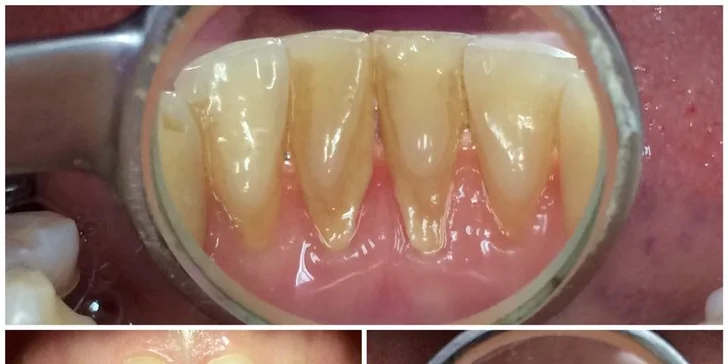 Profesionální dentální hygiena