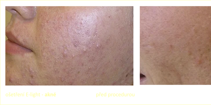 ACNE STOP - okamžité zlepšení mastné pleti