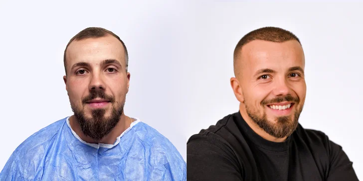 Pre a po - viac ako 8 mesiacov