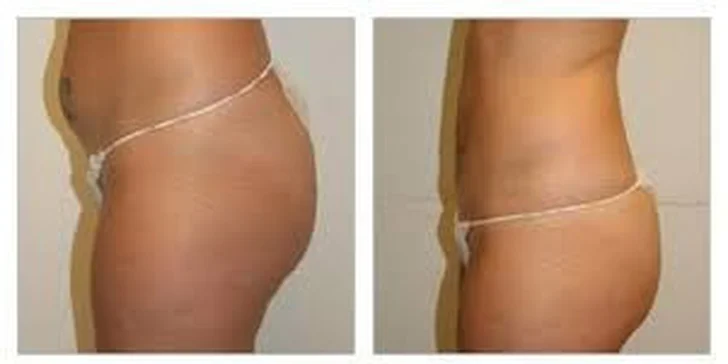 Neinvazivní liposukce v délce 30 minut