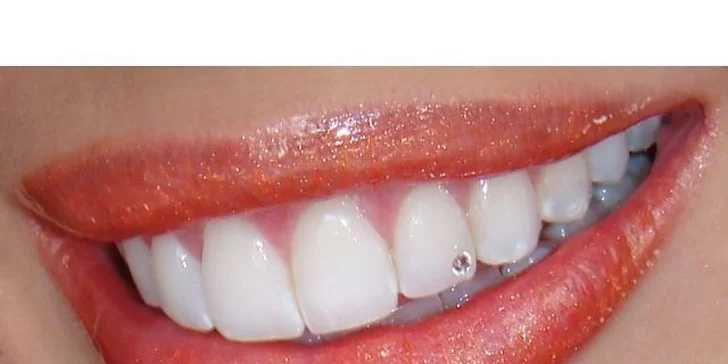 Dentální šperky - broušený křišťál do zubů