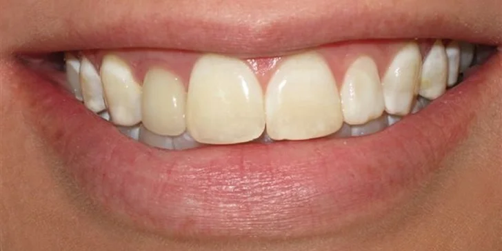 Veneers a Lumineers (keramické fazety) pro váš hollywoodský úsměv