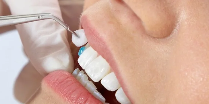Veneers a Lumineers (keramické fazety) pro váš hollywoodský úsměv