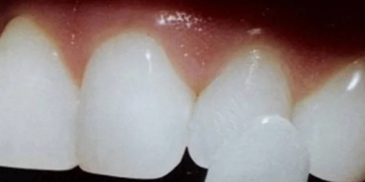 Veneers a Lumineers (keramické fazety) pro váš hollywoodský úsměv