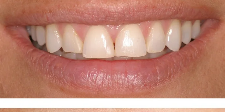 Veneers a Lumineers (keramické fazety) pro váš hollywoodský úsměv