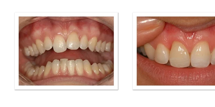 Veneers a Lumineers (keramické fazety) pro váš hollywoodský úsměv