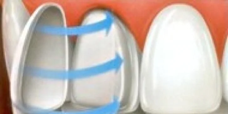 Veneers a Lumineers (keramické fazety) pro váš hollywoodský úsměv