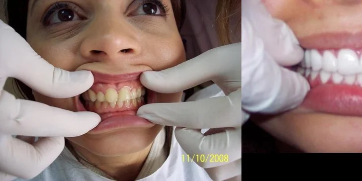 Veneers a Lumineers (keramické fazety) pro váš hollywoodský úsměv