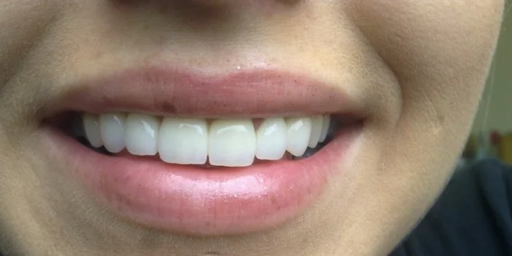 Veneers a Lumineers (keramické fazety) pro váš hollywoodský úsměv