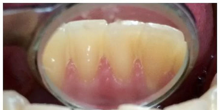 Profesionální dentální hygiena