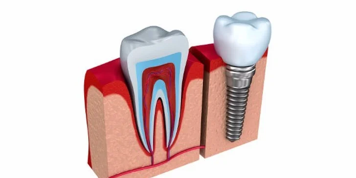 Zubní implantát Dentis - extra odolný