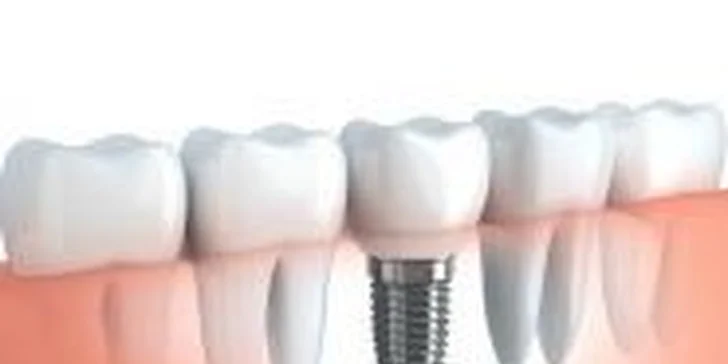 Zubní implantát Dentis - extra odolný