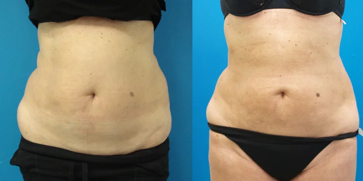 60minutová ultrazvuková liposukce v centru Brna