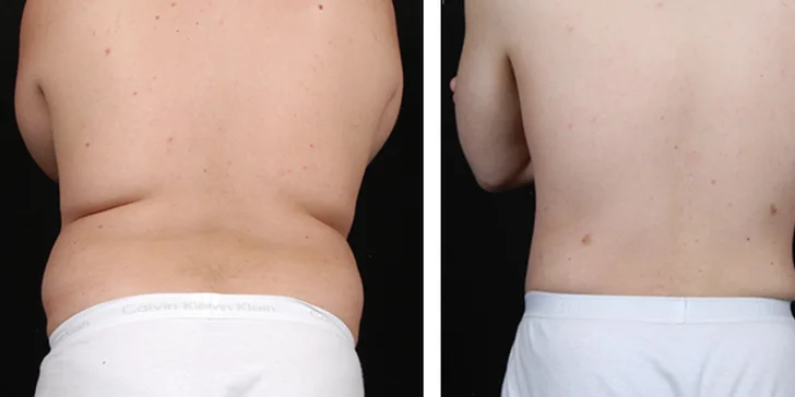 60minutová ultrazvuková liposukce v centru Brna