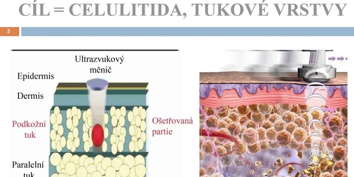 5 ošetření moderním ultrakavitačním přístrojem