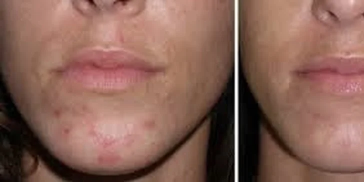 Laserová gelová maska včetně aplikace kyseliny hyaluronové