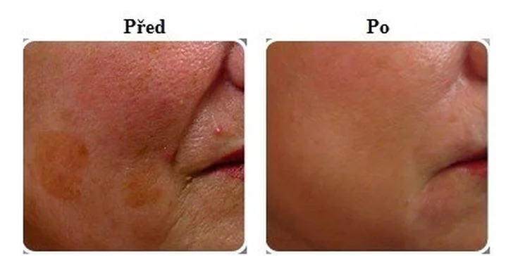 Redukce vrásek kyselinou hyaluronovou