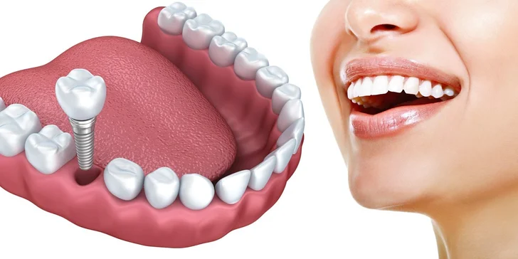 Aplikace zubního implantátu včetně dentální hygieny
