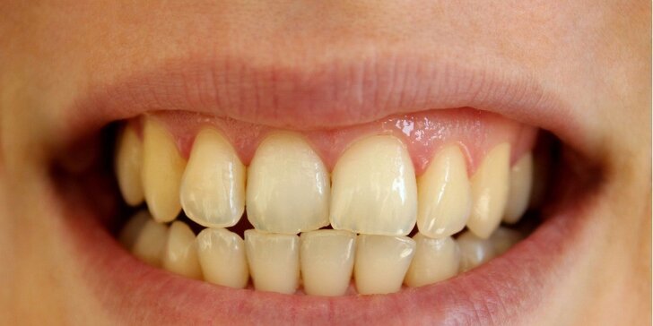 Šetrné bělení zubů neperoxidovým gelem
