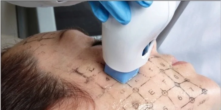 Neinvazivní lifting libovolné části těla metodou THERMAGE