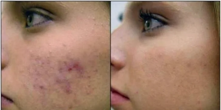 Karbonový laserový peeling pro problematickou pleť