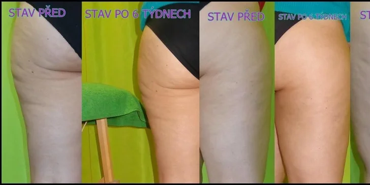 Anticelulitidní zábal s přístrojovou lymfatickou masáží