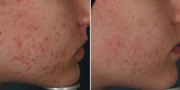 Před a po 2. aplikaci pulzního světla 