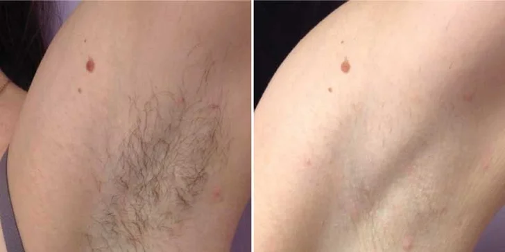 Výsledek po cca 4. ošetření IPL , kde je vidět, že se míra ochlupení výrazně oslabila. 