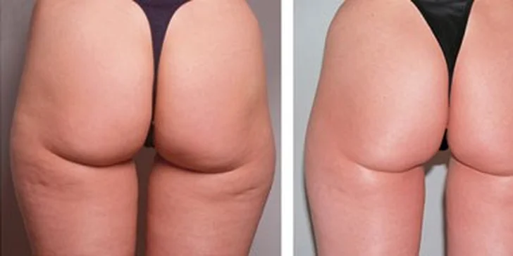 Přístrojová podtlaková masáž - účinná léčba celulitidy
