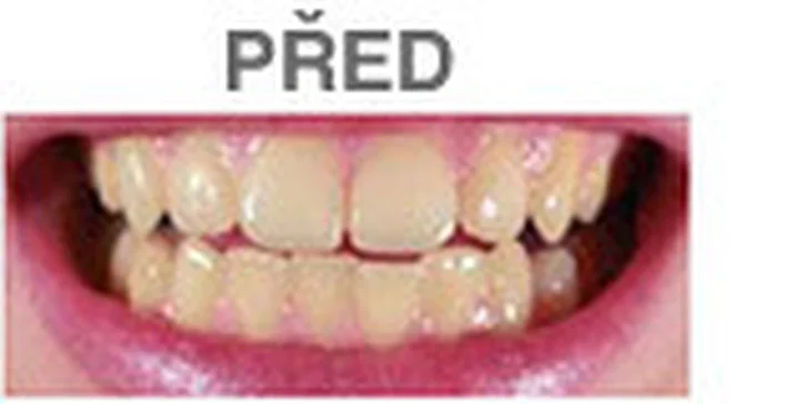 Šetrné a účinné bělení zubů bez peroxidu! 30minutové ošetření metodou Smile Brilliant pro krásný a zdravý úsměv v pražském Image Studiu.
