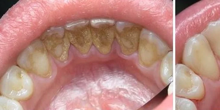 Precizní dentální hygiena s air flow na klinice ArtStom