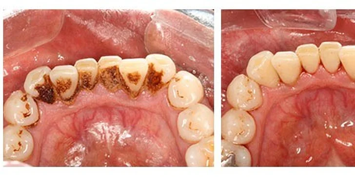 Precizní dentální hygiena s air flow na klinice ArtStom