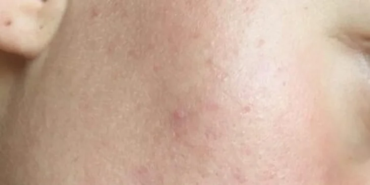 Na místě vás čeká jedno z ošetření, která léčí těžší formy akné a zánětů.