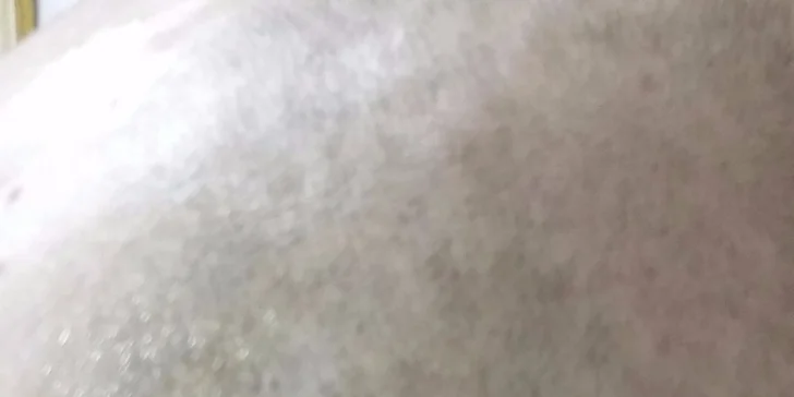 Akupunktura na hubnutí nebo proti kouření