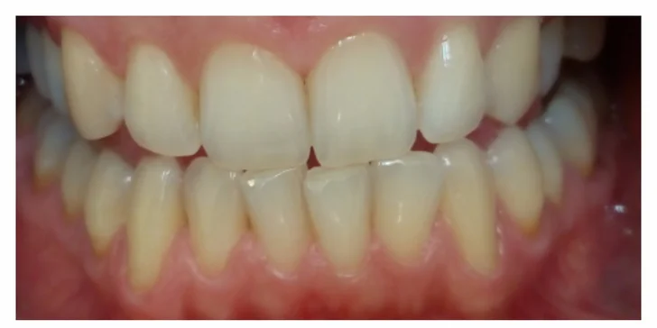 Profi bělení zubů pro krásný úsměv a 30% sleva na dentální hygienu