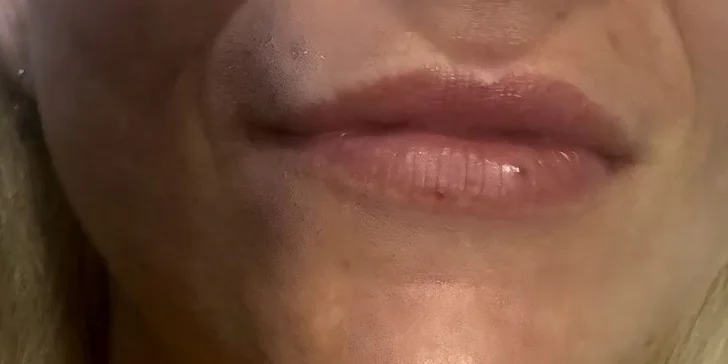 Vede také k redukci vrásek nebo k prevenci stárnutí pleti. 
