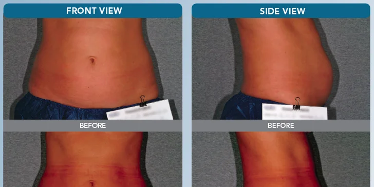 Mimořádně efektivní neinvazivní liposukce Ulthera Slim – až 10 ošetření