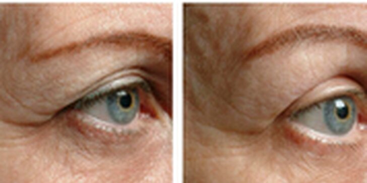 Thermage - ošetření očního okolí, obličeje nebo obličeje a dekoltu