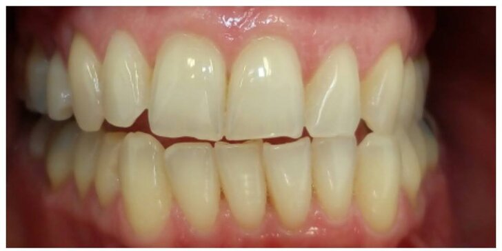 Ordinační bělení zubů pro zářivý úsměv