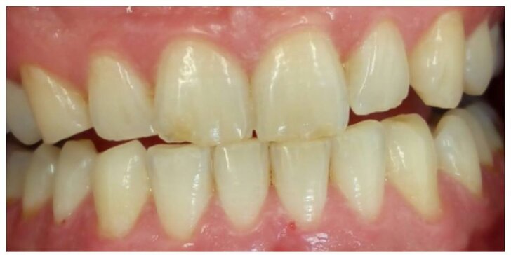 Odborné bělení zubů: Darujte pod stromeček zářivý úsměv