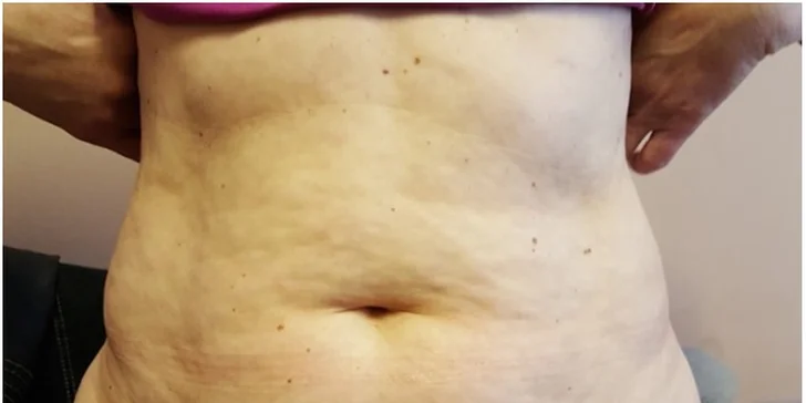 Bezbolestná liposukce: kavitace, lipolaser a lymfodrenáž