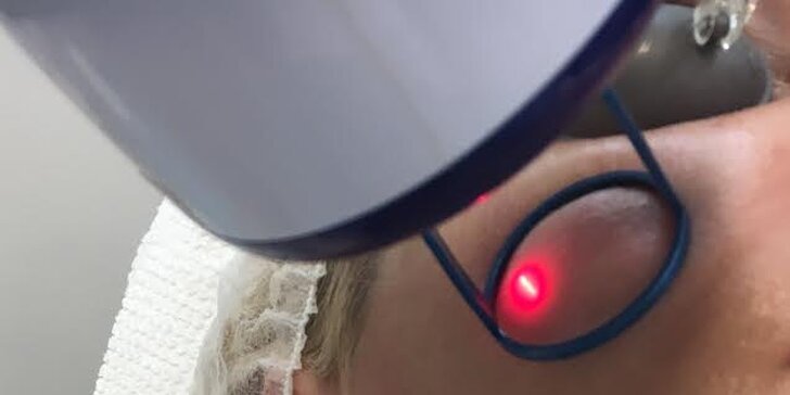 Omládněte bez skalpelu - Omlazení očního okolí frakčním laserem