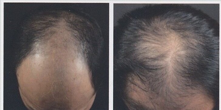 Ošetření pro růst vlasů - alternativa transplantace!